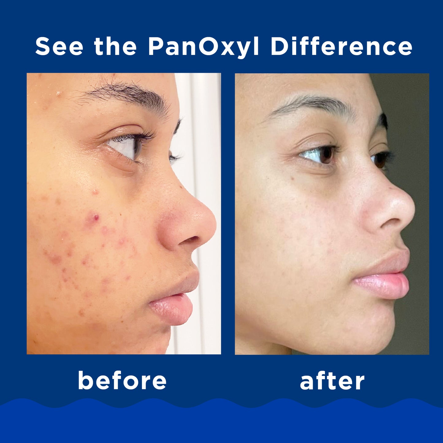 PanOxyl Acne Foaming Wash Benzoyl Peroxide 10% Maximum Strength